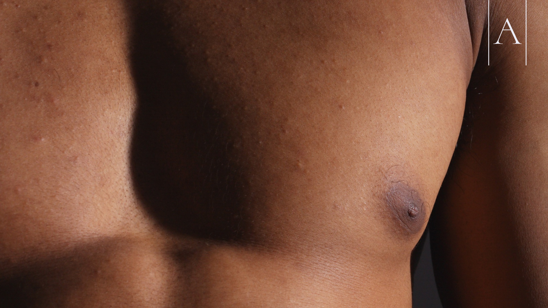 How to Prepare for Gynecomastia Surgery: A Step-by-Step Checklist 3 19b649131f6140378761021f2720f342
