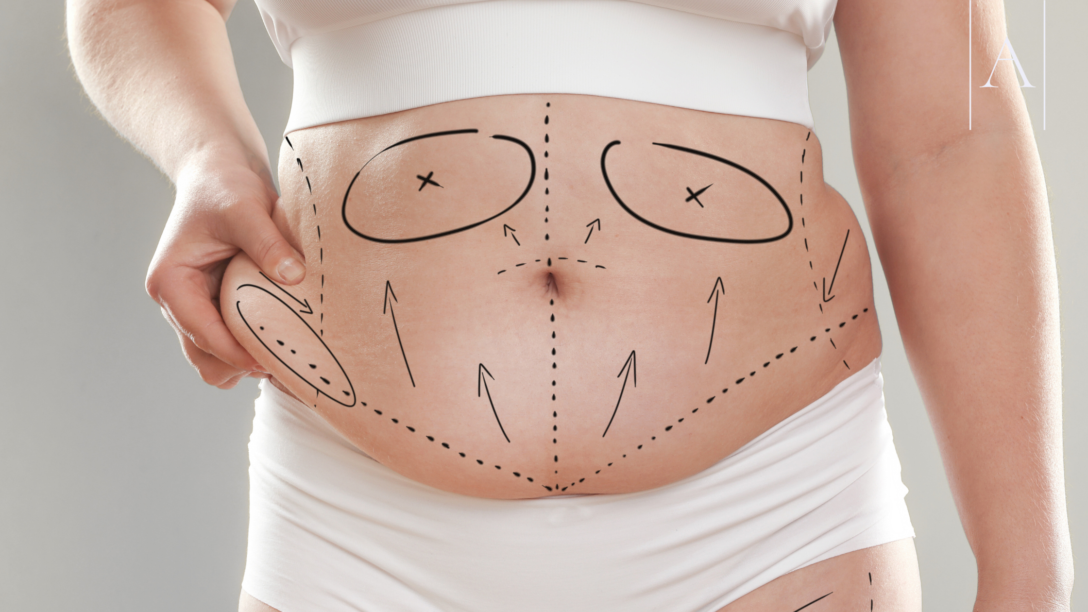 Combining Abdominoplasty and Hernia Repair: Benefits, Risks & Recovery Explained 9 28a26fb08bce4867bbc2983c5b8520cf