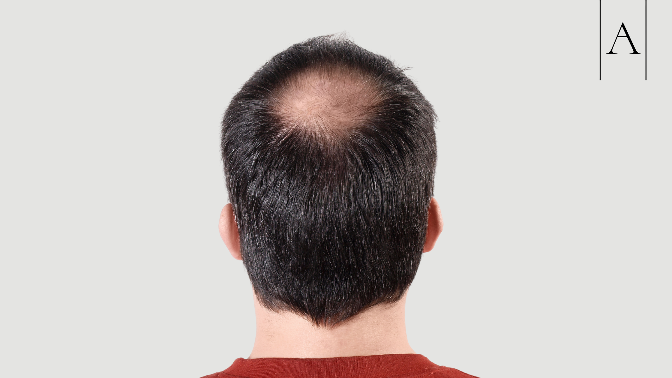 Weight Loss Jabs and Hair Loss: What's Really Happening? 3 a6cff7b6929c4189810d7447f9d573ed