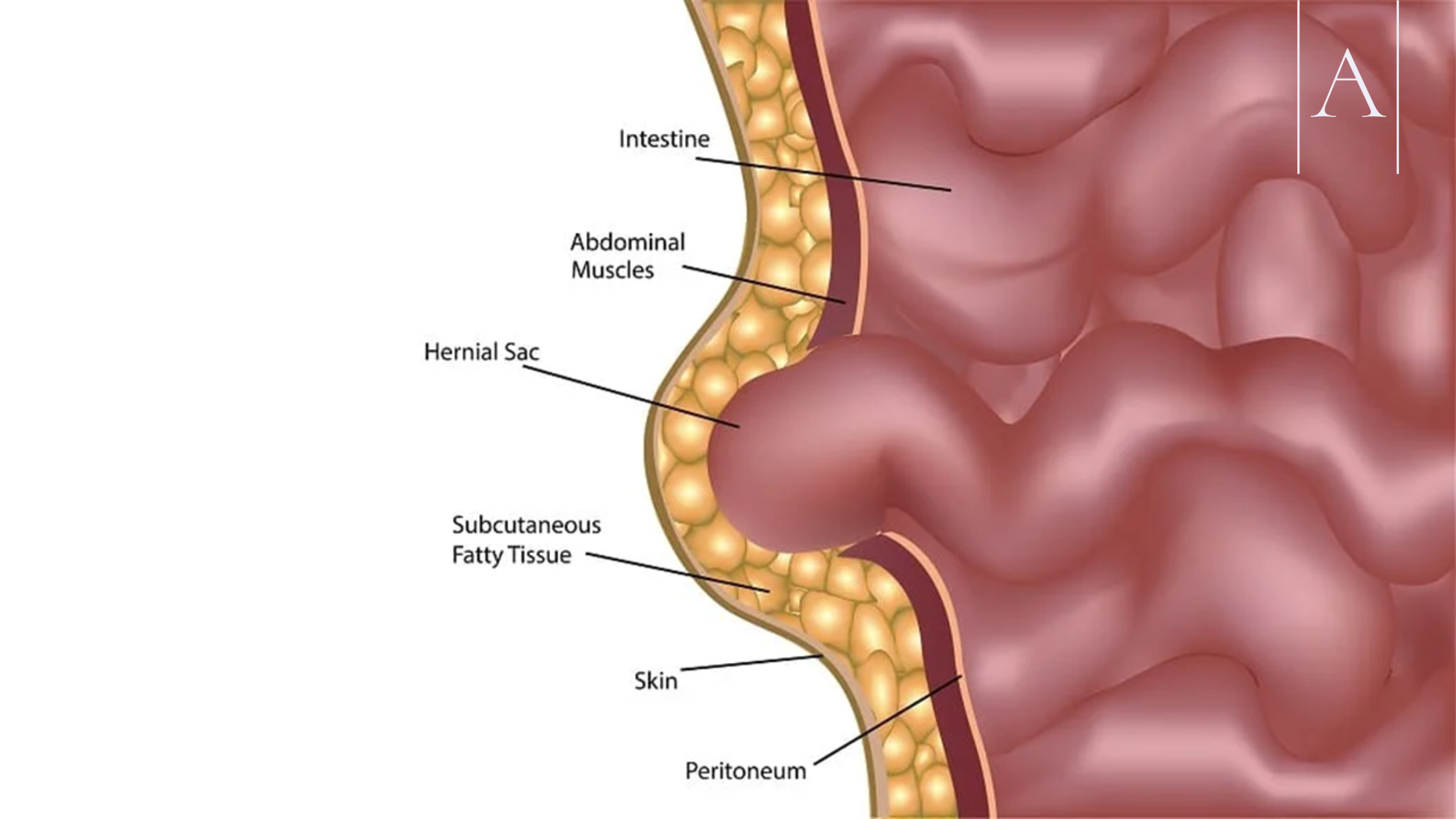 Combining Abdominoplasty and Hernia Repair: Benefits, Risks & Recovery Explained 3 a70a9f22e5044c99b7adb939030c38ef
