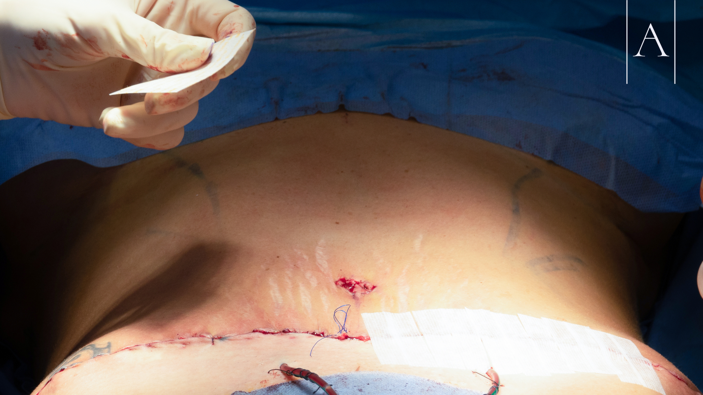 Combining Abdominoplasty and Hernia Repair: Benefits, Risks & Recovery Explained 5 ccf0fc351c0744a190bbe2f877c5aa82