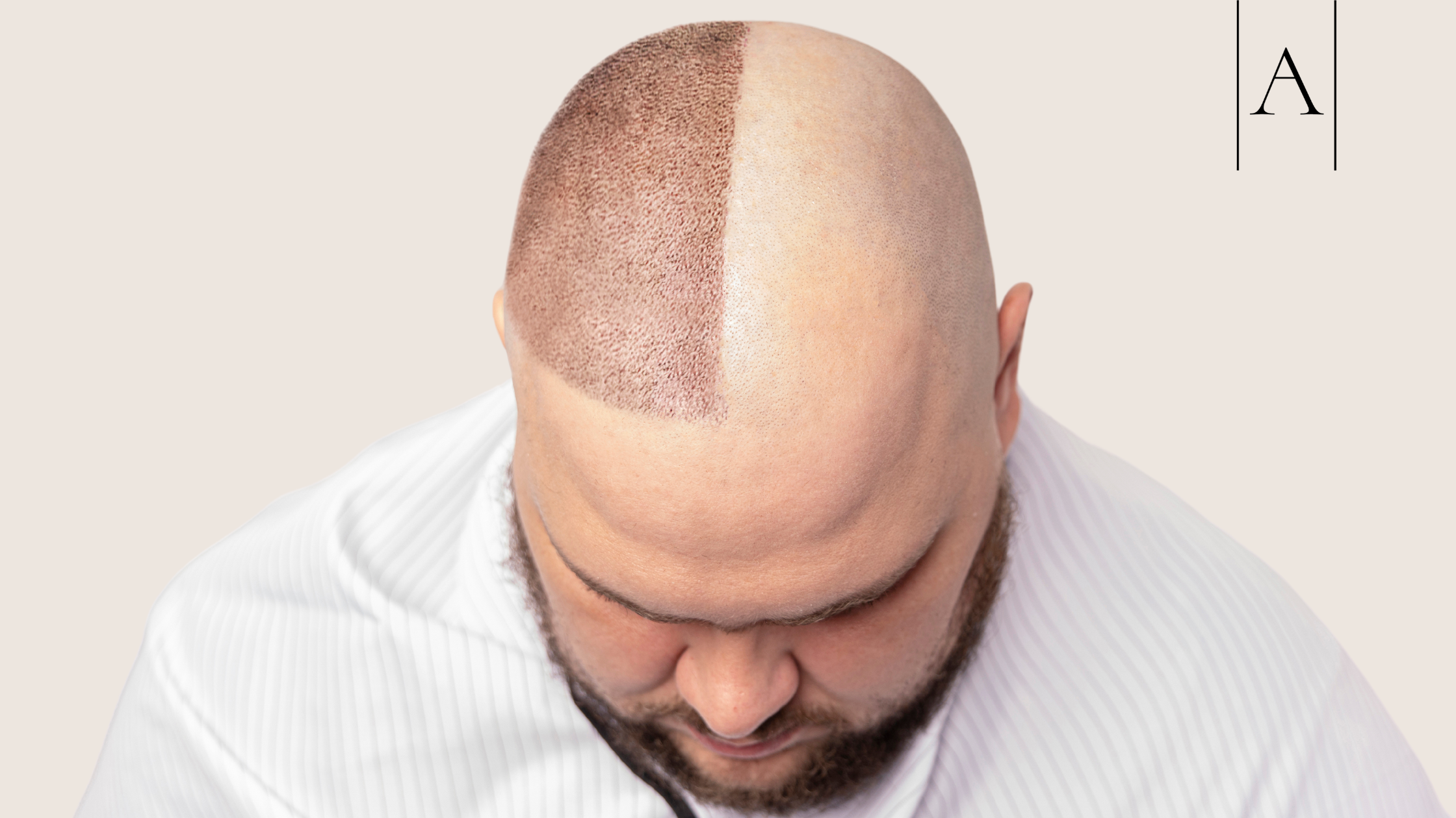 New Look, New Life: Redefining Confidence with Asthetica’s Luxury Medical Tourism for Men 1 New Look, New Life: Asthetica's Medical Tourism for Men in Turkey