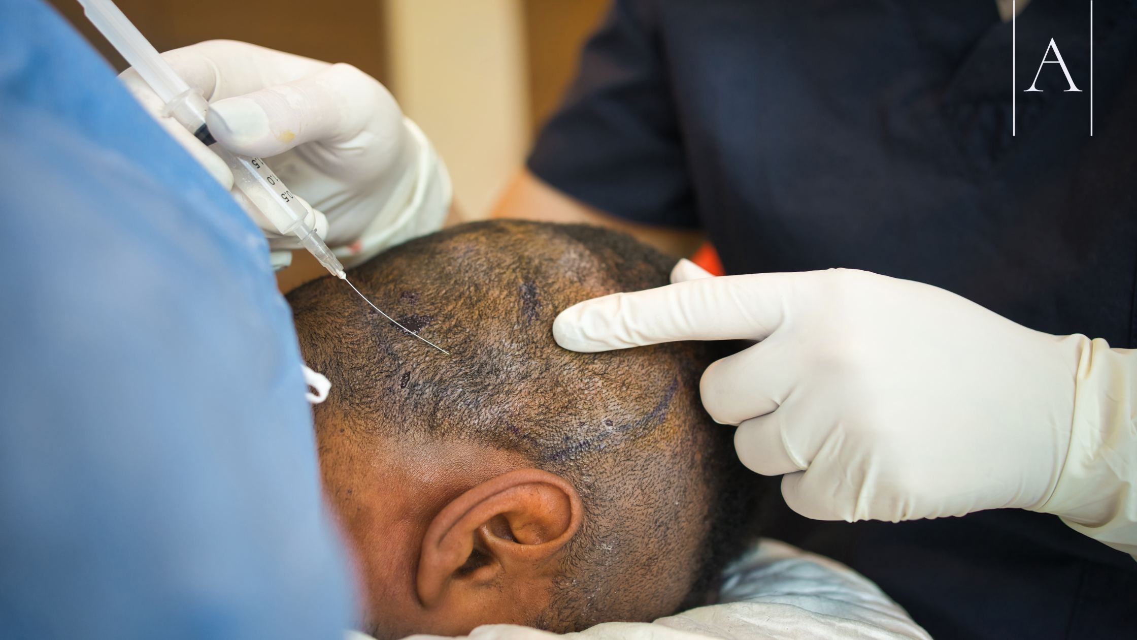 Can Donor Hair Grow Back After a Transplant? 3 eef351b690d74b2ca900e901ab8b9ef3