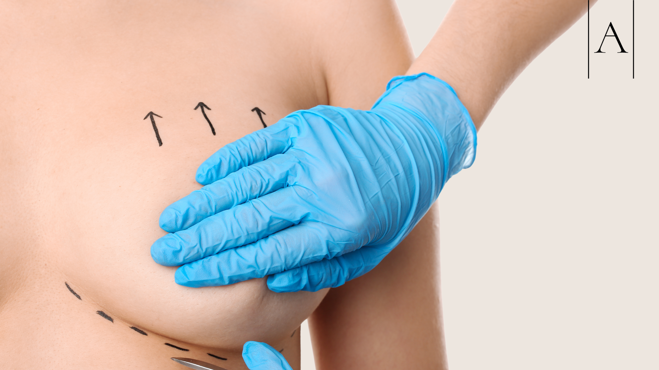 Breast Lift with Implants: The Perfect Combination? 2 f32e46d84e184c0b89f70d86f2637f86