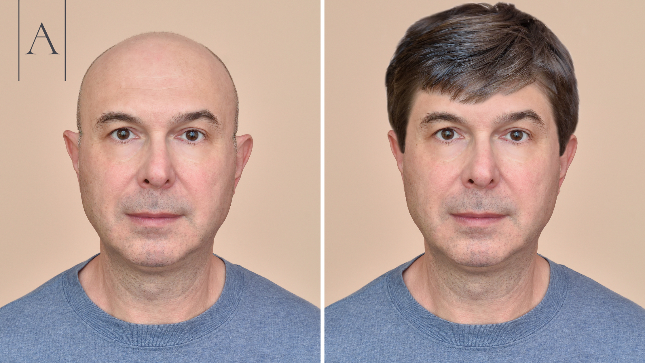 Benefits of Hair Transplants