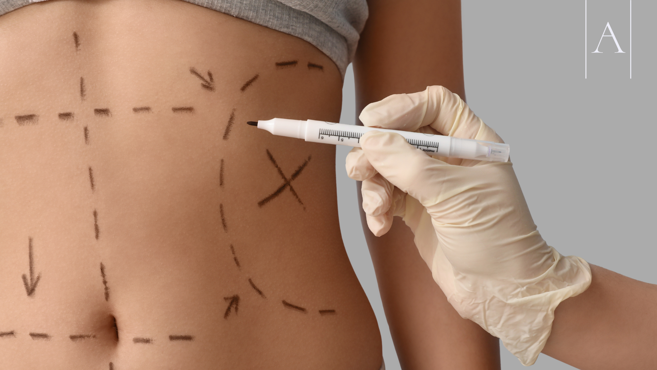 Combining Abdominoplasty and Hernia Repair: Benefits, Risks & Recovery Explained 6 ff749f3754c740eb8c25792b066a7aef