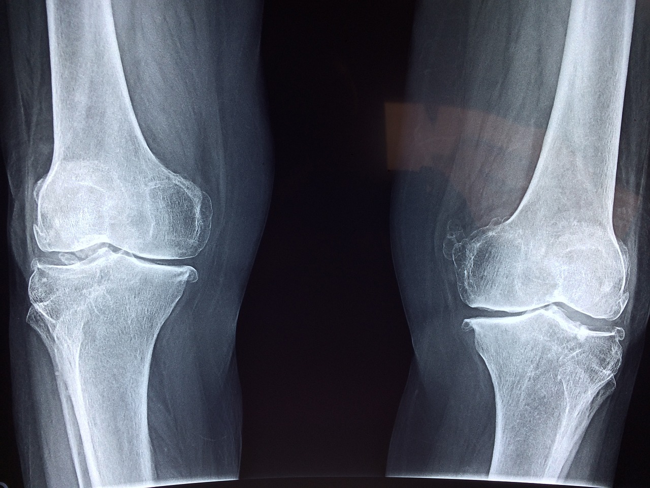 What is Chondrosarcoma and Its Symptoms
