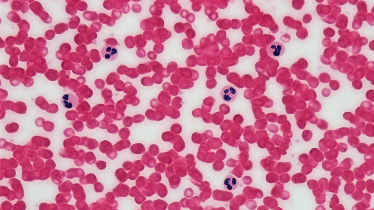 What Is Acute Biphenotypic Leukemia and How Is It Defined