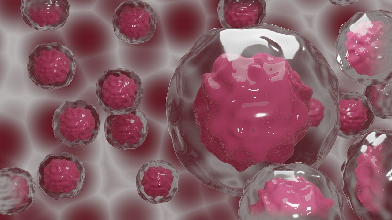 Diagnosing Ductal Carcinoma In Situ