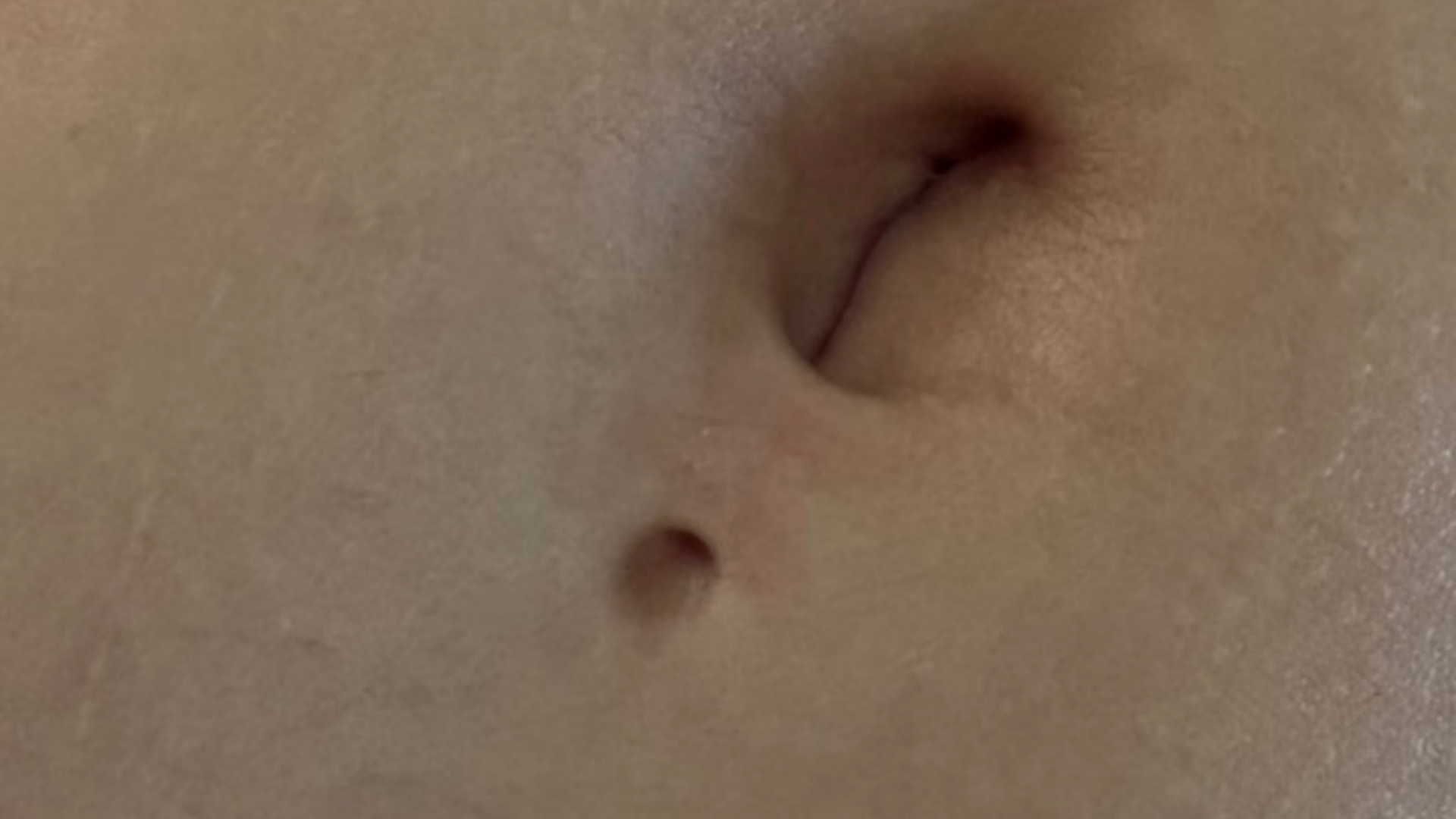 Chéloïdes après piercing au nombril : reconnaître et différencier