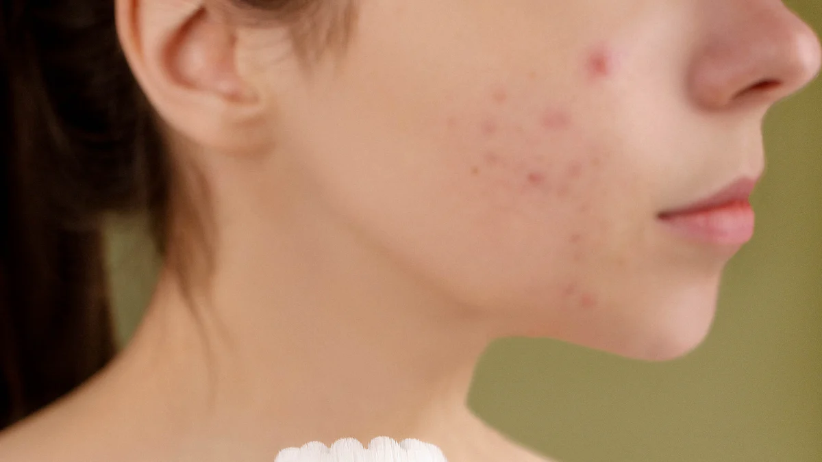 How to Choose the Right Pimple Patch