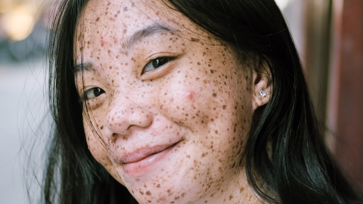 Top 10 Pimple Patches for Acne-Prone Skin in 2025