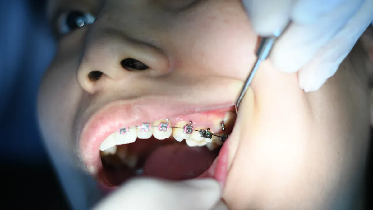 Are self-ligating braces the ultimate choice for efficient tooth movement?