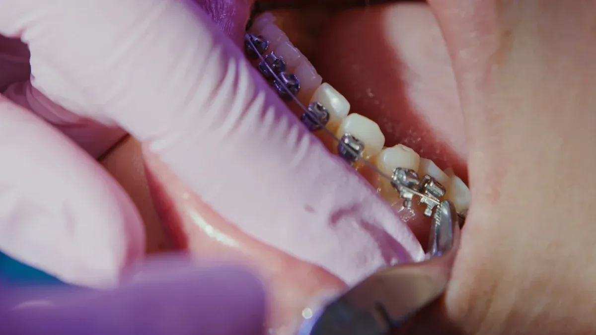 What Are Orthodontic Brackets?