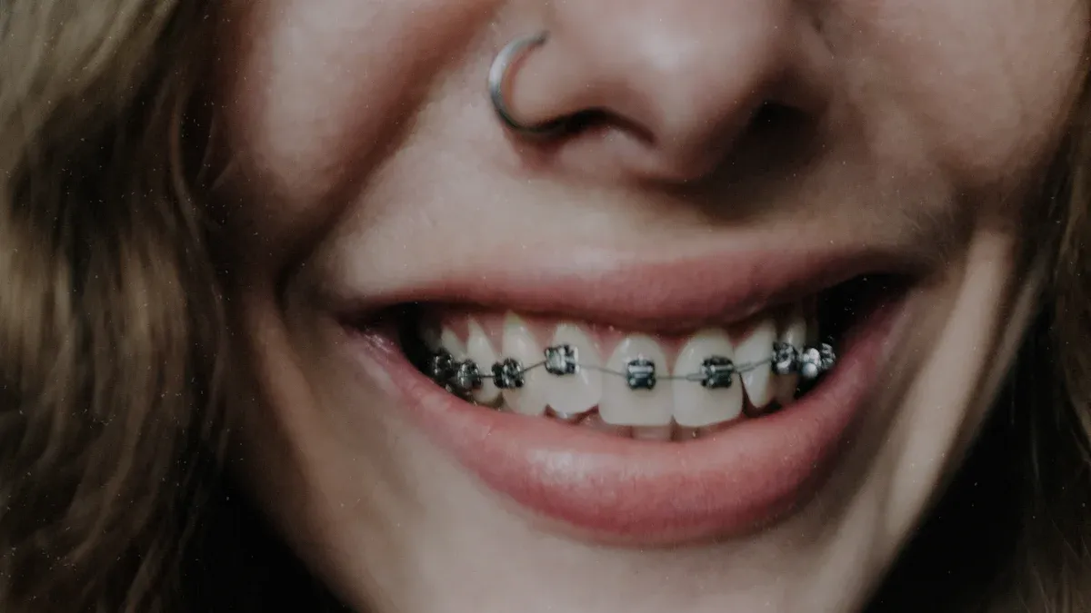 Enhanced Patient Experience and Durability with Self-Ligating Brackets