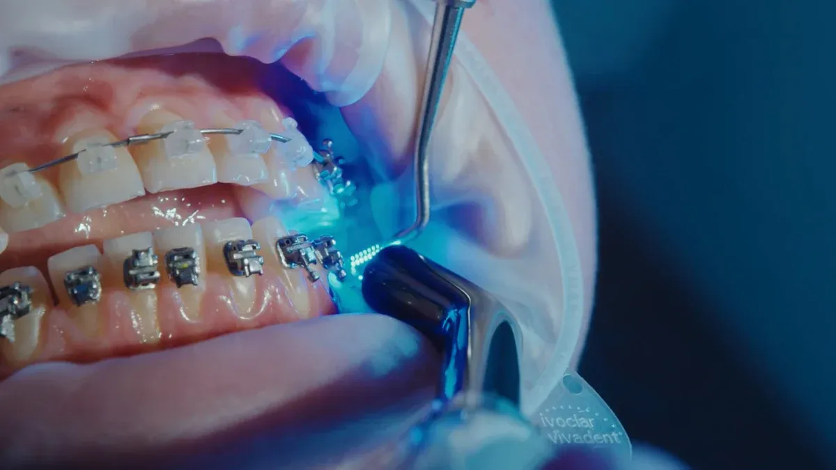 Choosing the Right Arch Wire for Your Patients: A Dentist’s Handbook