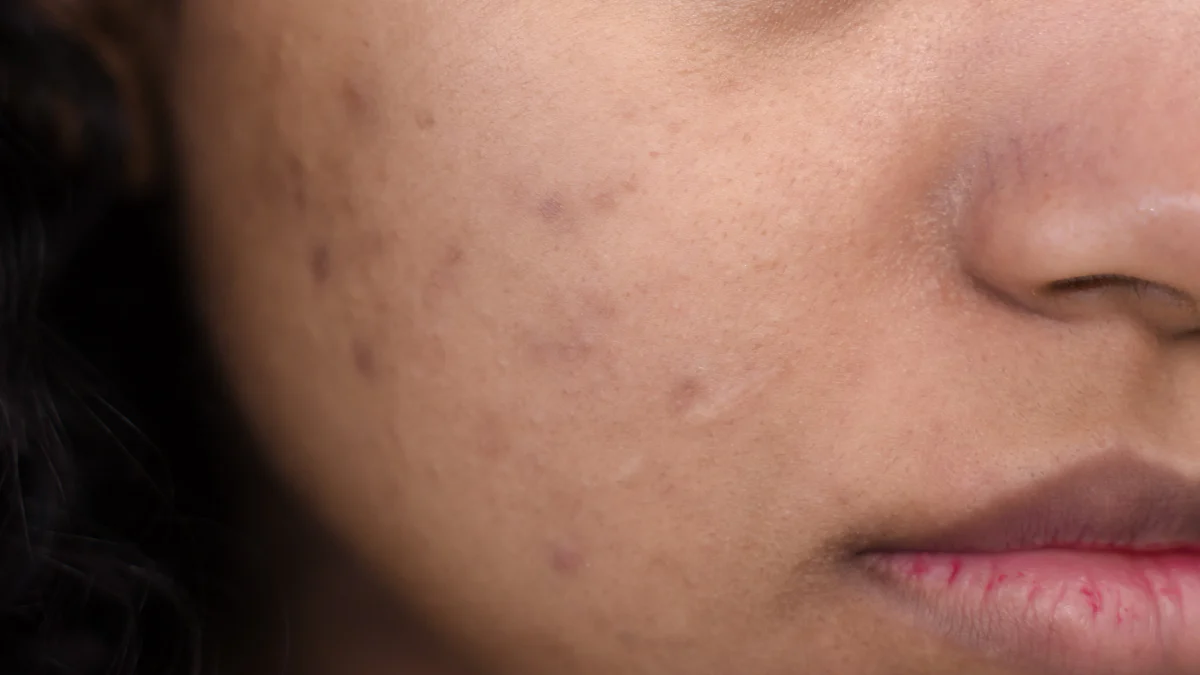 How Advanced Dark Spot Patches Help Fade Post-Blemish Marks