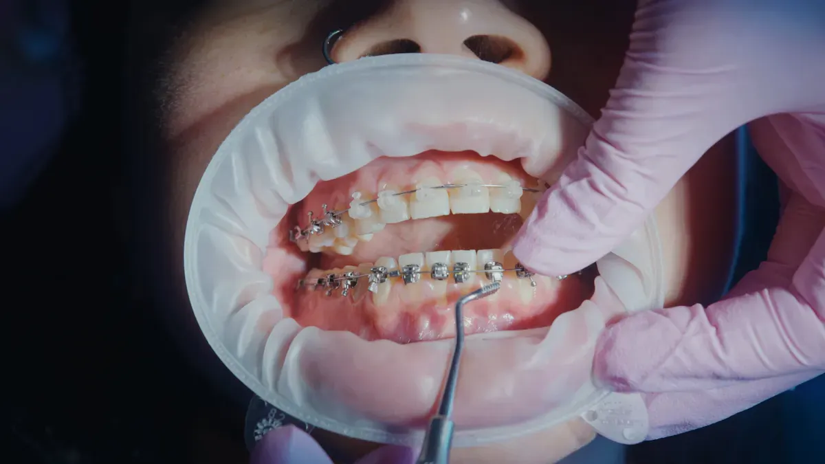 How Orthodontic Self Ligating Braces Work