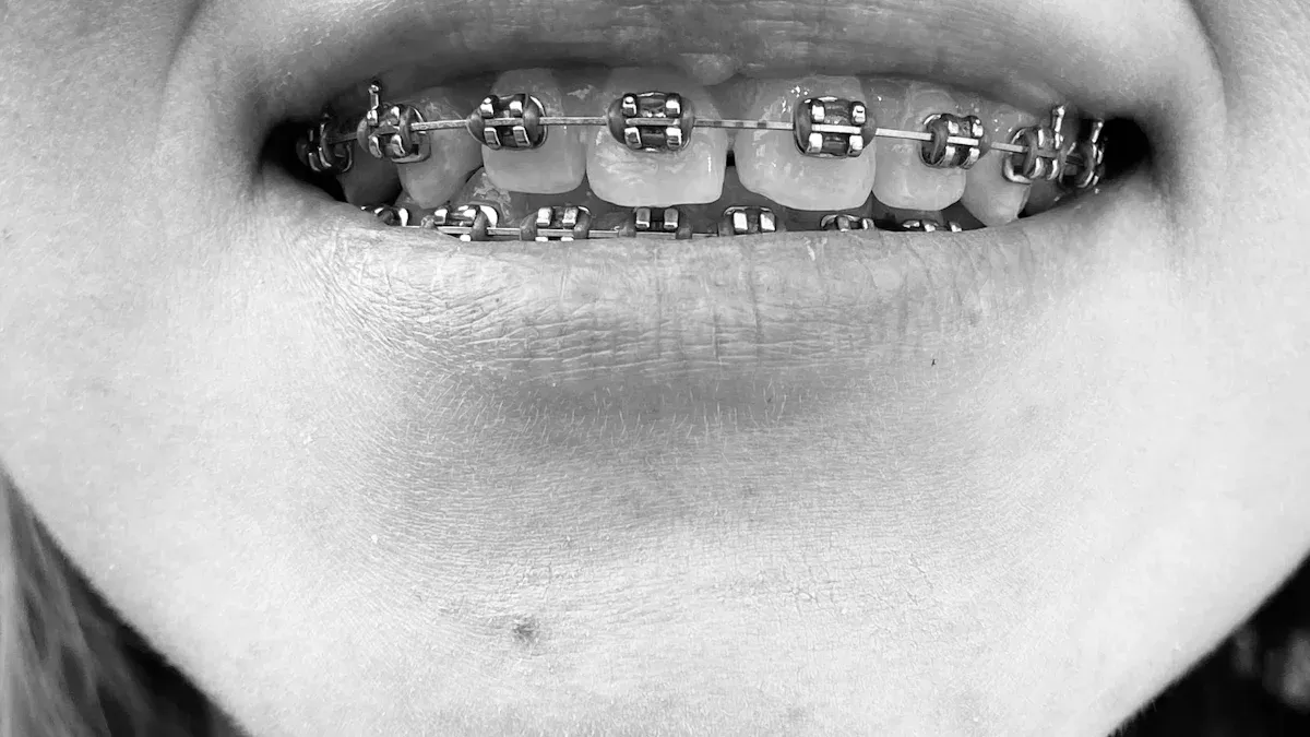What Are the Key Differences Between Traditional and Self-Ligating Braces?
