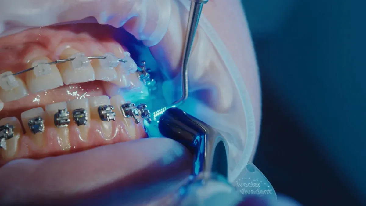 Ceramic Orthodontic Brackets