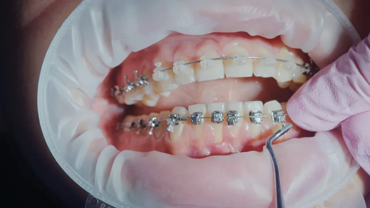 How to Choose the Perfect Orthodontic Brackets for Your Practice