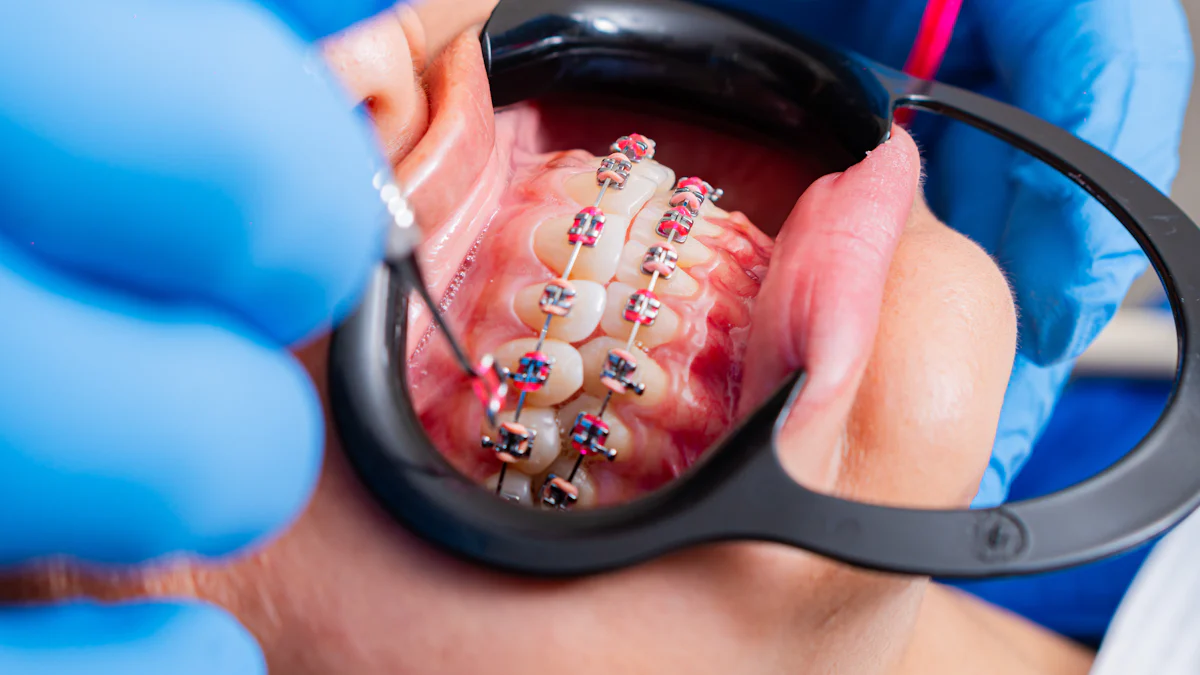 How Self Ligating Brackets – Active – MS1 Work