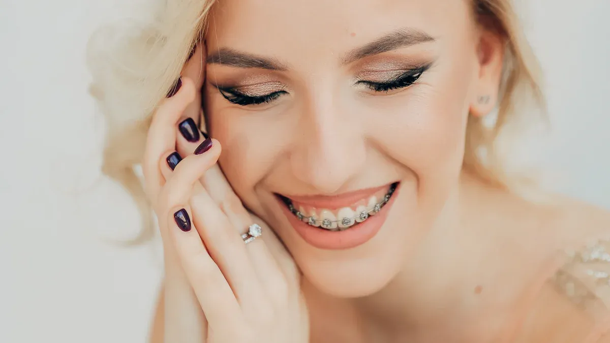 Aesthetic Appeal of Self-Ligating Brackets