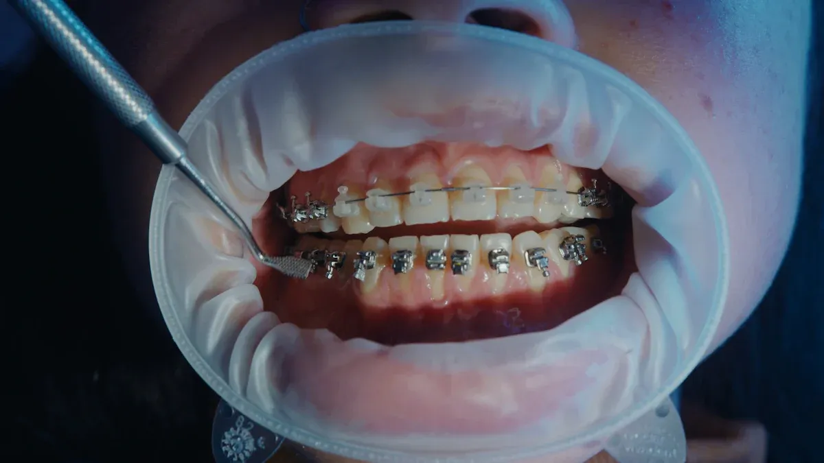 Why All-Metal Self-Ligating Brackets are the Top Choice for Modern Efficient Orthodontics?