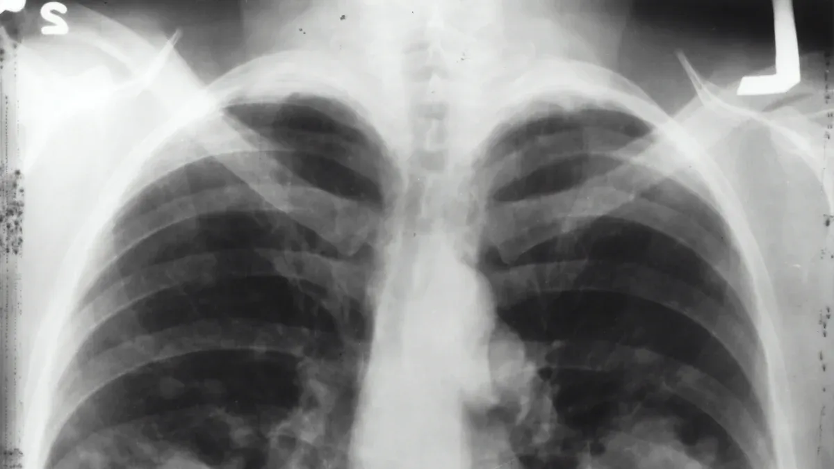 Lung Injuries from THC Vapes