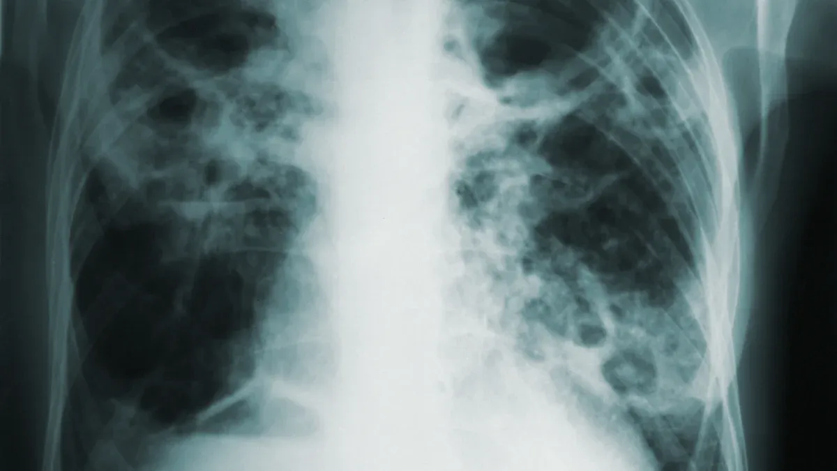 Mechanisms of Lung Injury