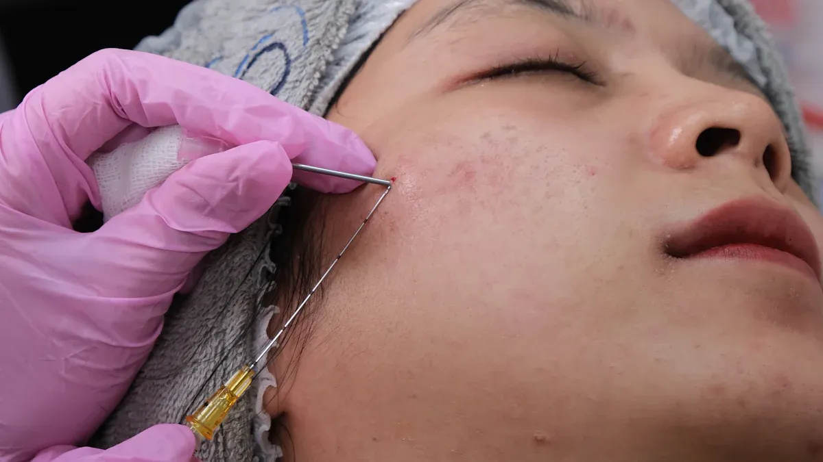 What Is RF Microneedling?