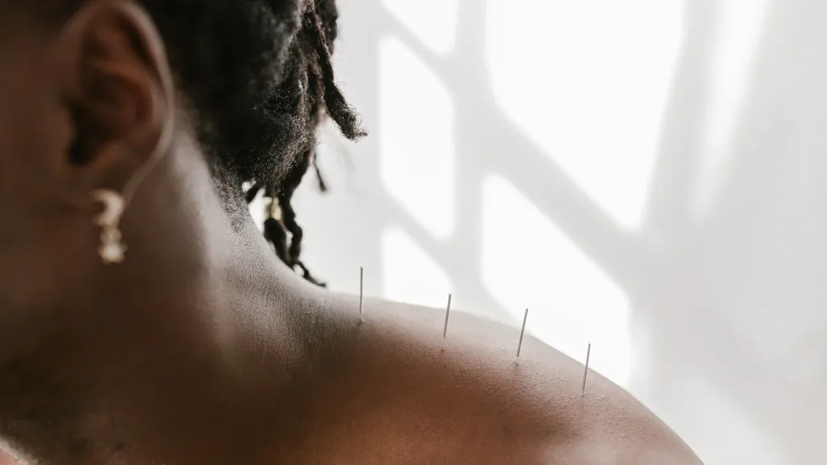 Acupuncture for back pain, anxiety, migraines: conditions treated and is it right for you?