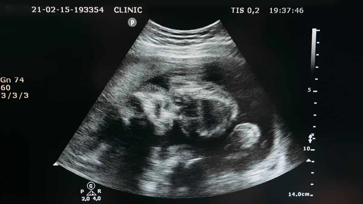 Echocardiogram Ultrasound