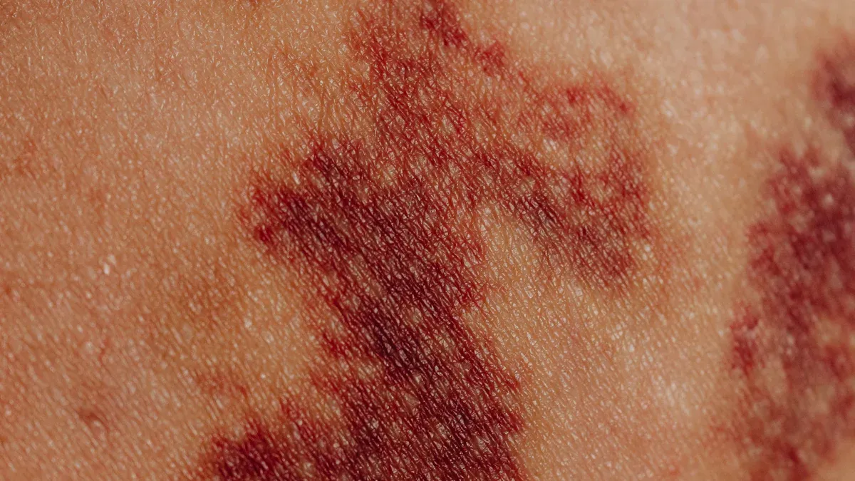 Understanding psoriasis dermatitis seborrhea