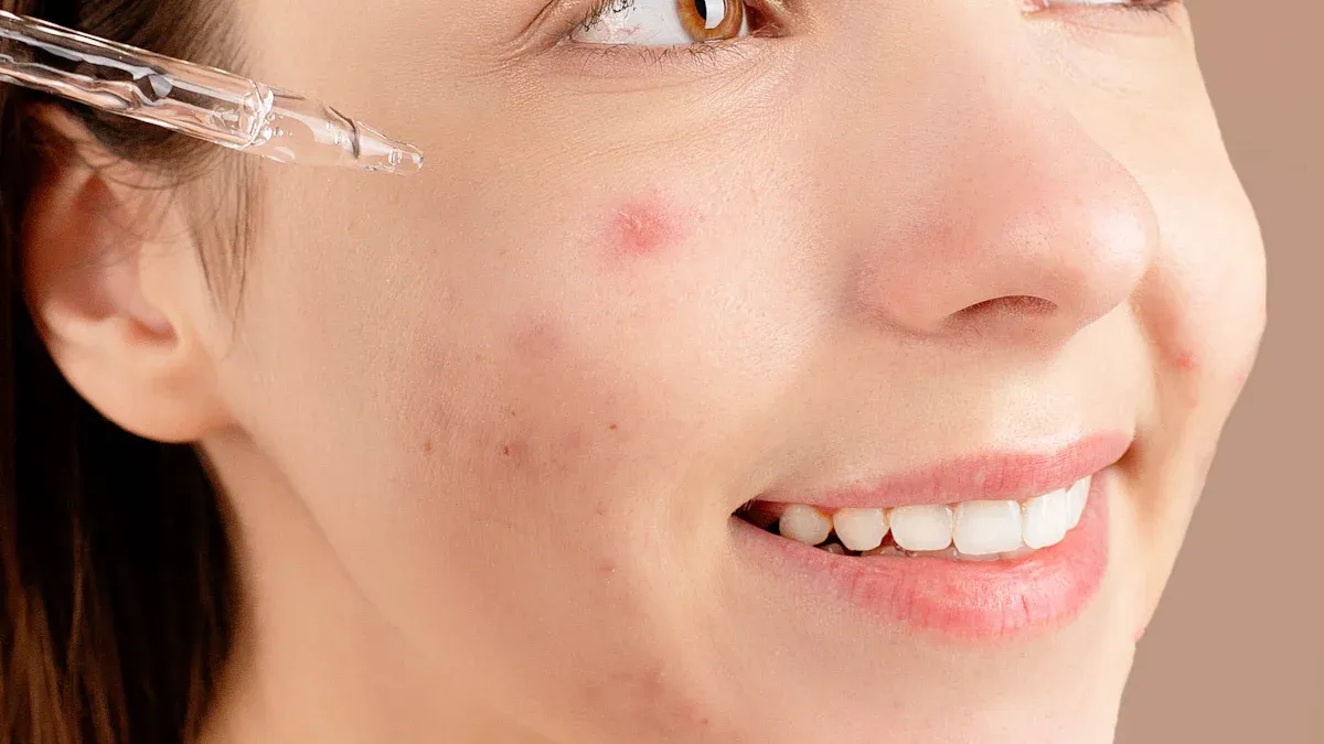 Hypochlorous Acid for Redness Sensitivity Acne