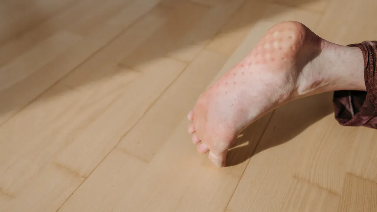 Managing Swollen Ankles Without Socks