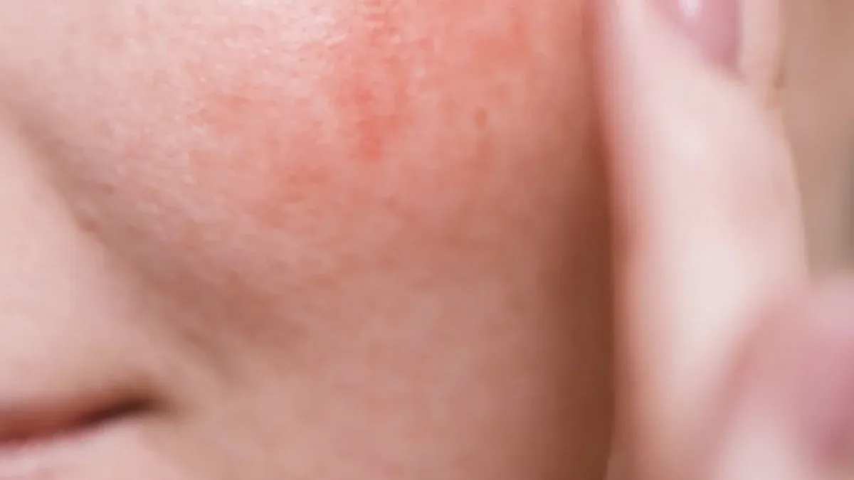 Understanding Rosacea and Sun Sensitivity | Tinted Sunscreen for Rosacea