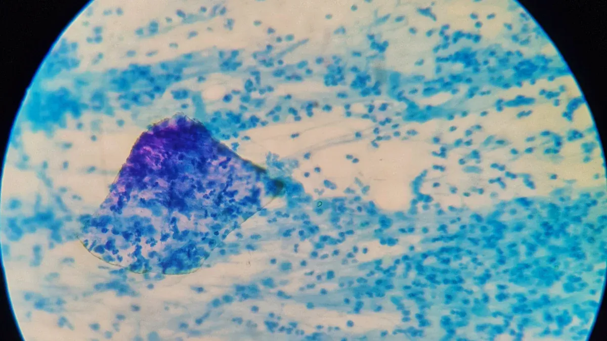 How to Understand Your Biopsy and Pathology Reports