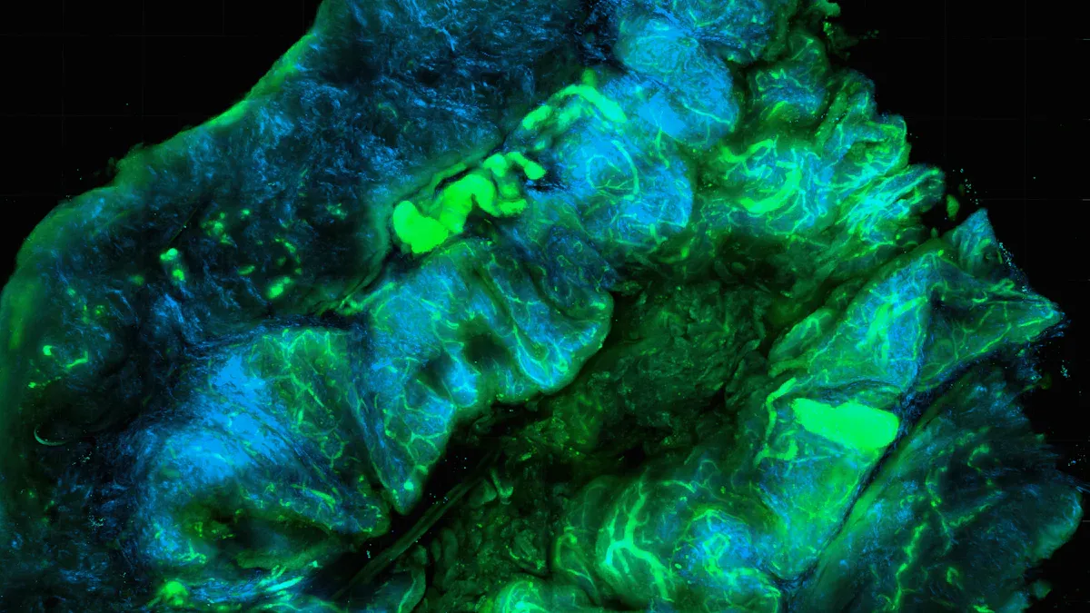 Stromal Disruption in Breast Cancer