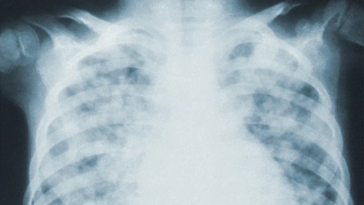 Symptoms of Non Small Cell Lung Carcinoma