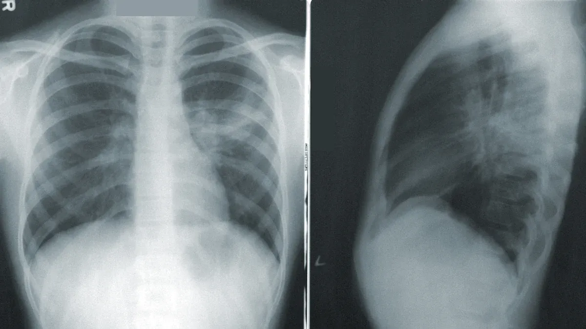 Symptoms of Lung Cancer in Non-Smokers