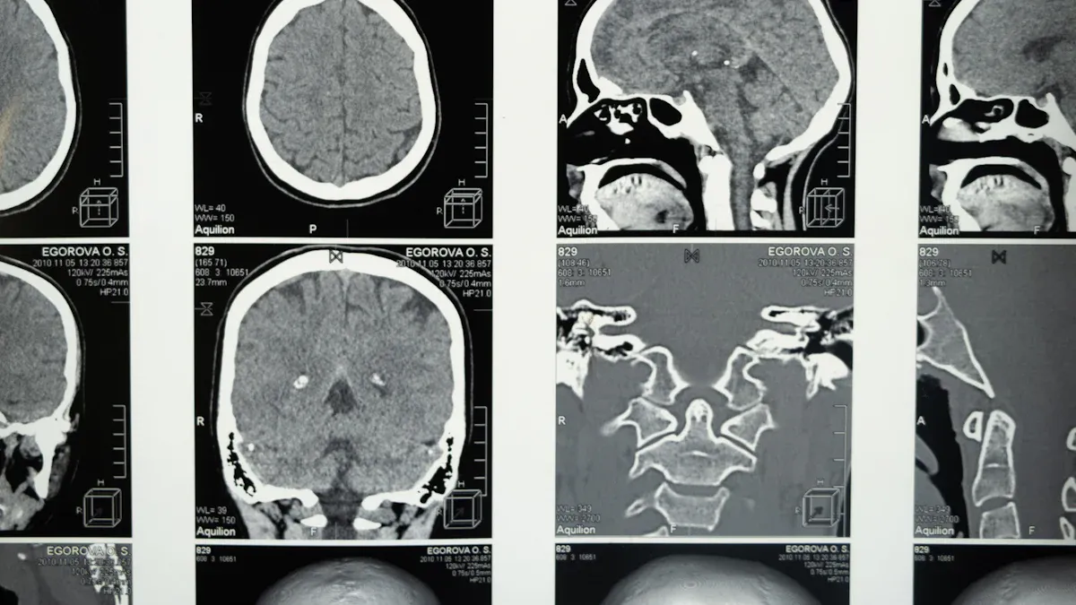 Diagnosis Methods for Optic Nerve Glioma