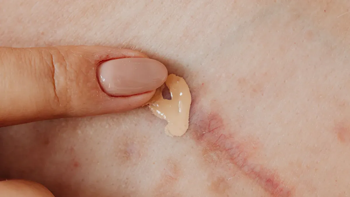 Can Scars from Surgery Turn into Cancer?