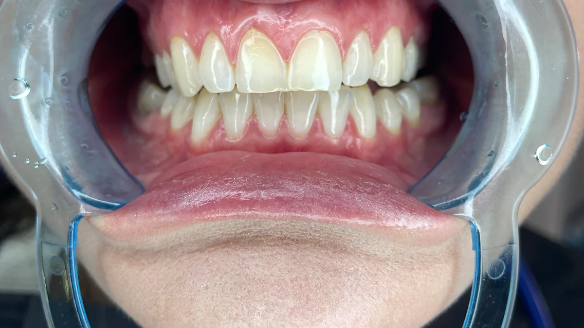 What is a Gingival Mask and How Does It Help in Dentistry