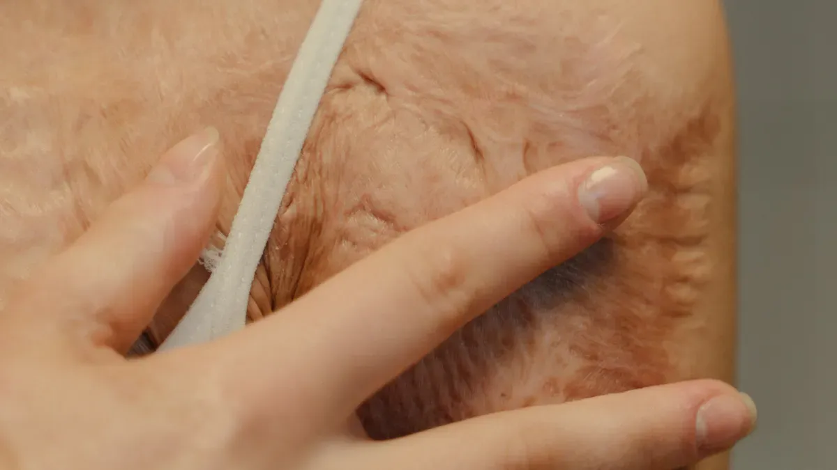 Comprendre les chéloïdes après un piercing