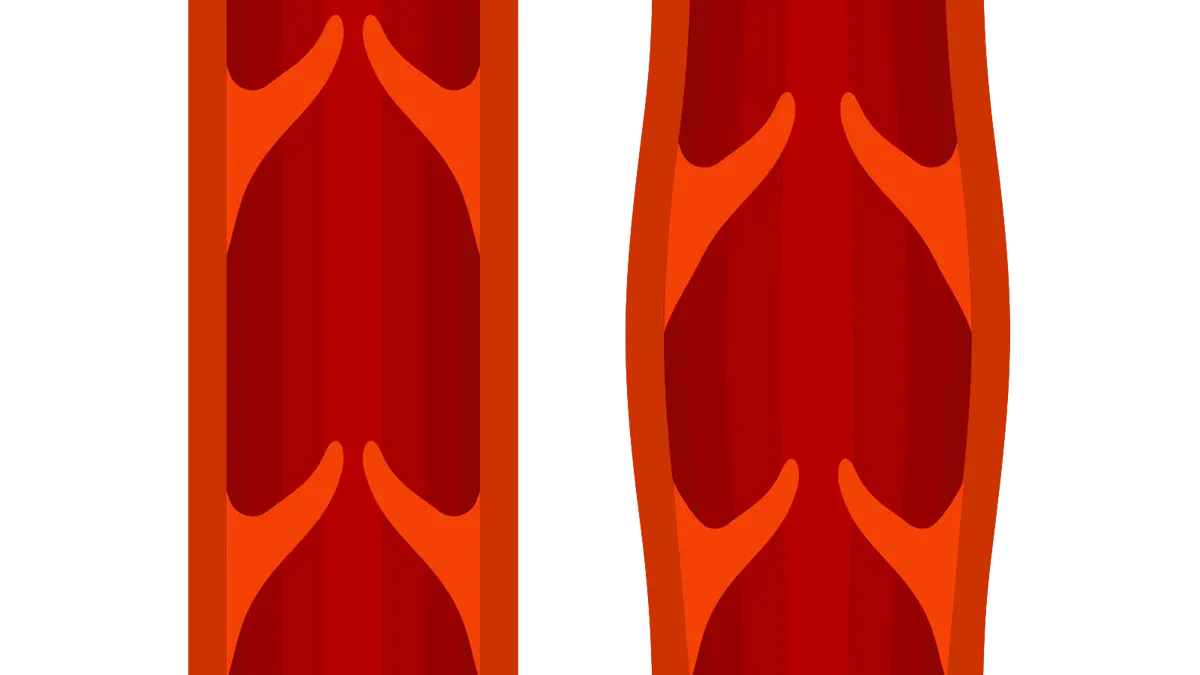 Varicose Veins Overview