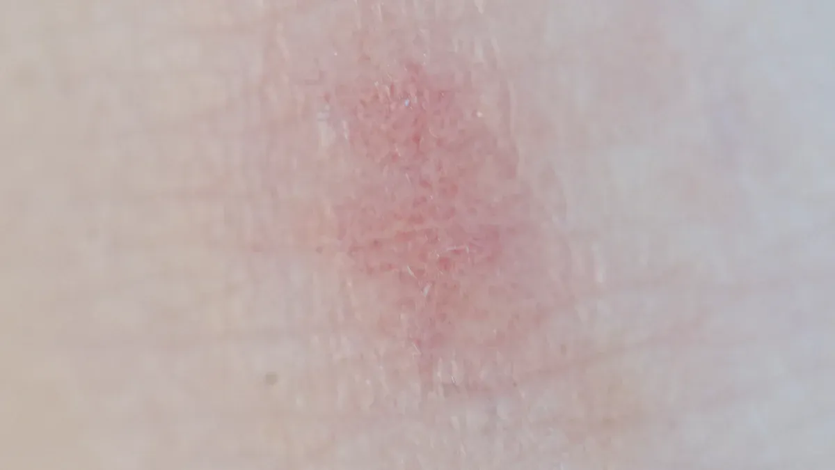 Allergic reactions to fumaric acid