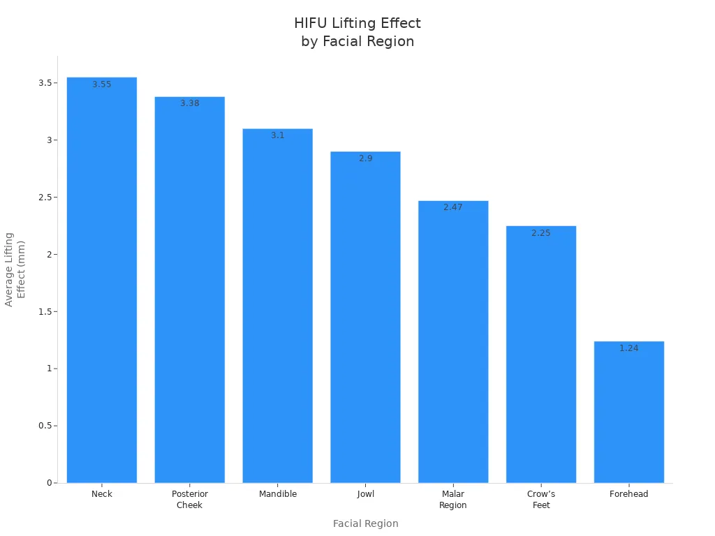 Bar chart showing average lifting effect in mm for seven facial regions after HIFU treatment